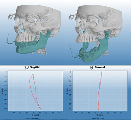 普兰梅卡 Planmeca 4D Jaw Motion 咬合追踪