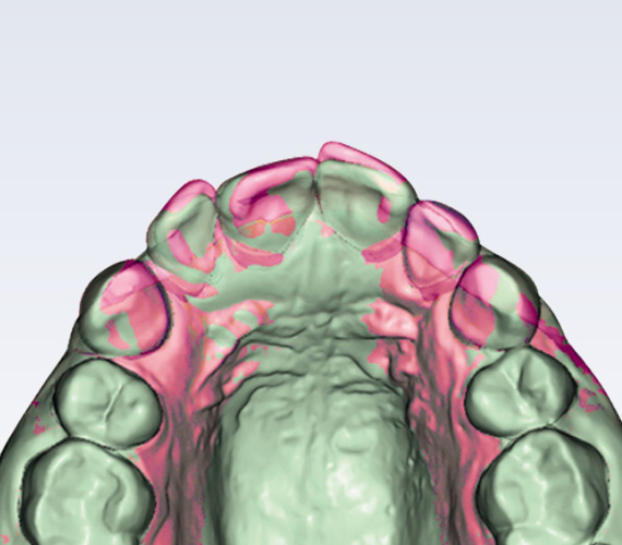 普兰梅卡 Planmeca Romexis Ortho Studio 正畸治疗后续检查