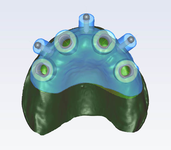 普兰梅卡 Planmeca Romexis 3D 粘膜支持