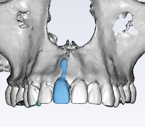 普兰梅卡 Planmeca Romexis Ortho Studio 正畸治疗计划