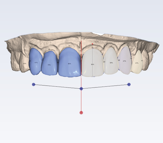 普兰梅卡 Planmeca Smile Design CAD/CAM 正畸治疗