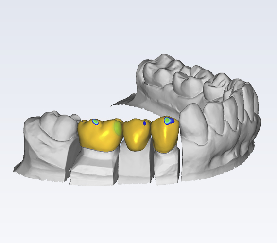 普兰梅卡 Planmeca PlanCAD Premium 个性化CAD/CAM 软件