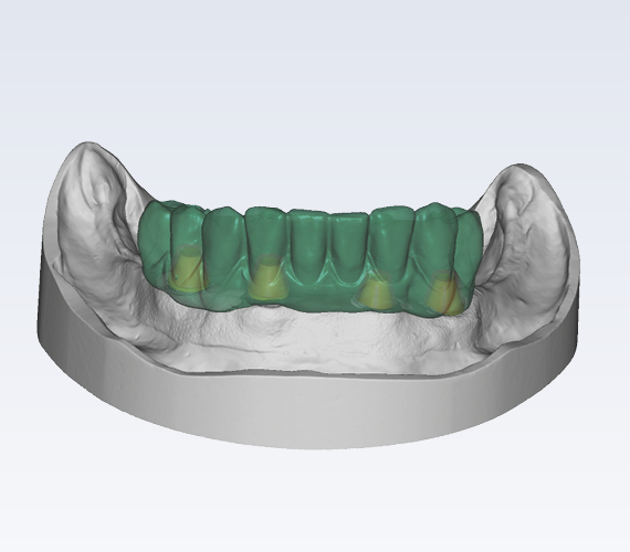 普兰梅卡 Planmeca PlanCAD Premium 软件 STL 文件