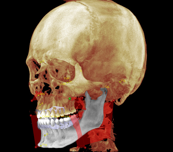 普兰梅卡 Planmeca Romexis 自动 3D 视图